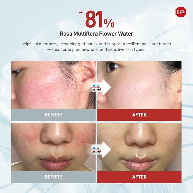 Zeroca 81 Serum – Korean Wild Rose Serum for Acne-Prone & Sensitive Skin – Balances Oil-Water, Soothes Redness, Fades Post-Blemish Marks, Firms & Hydrates 1.01 oz. 30 ml